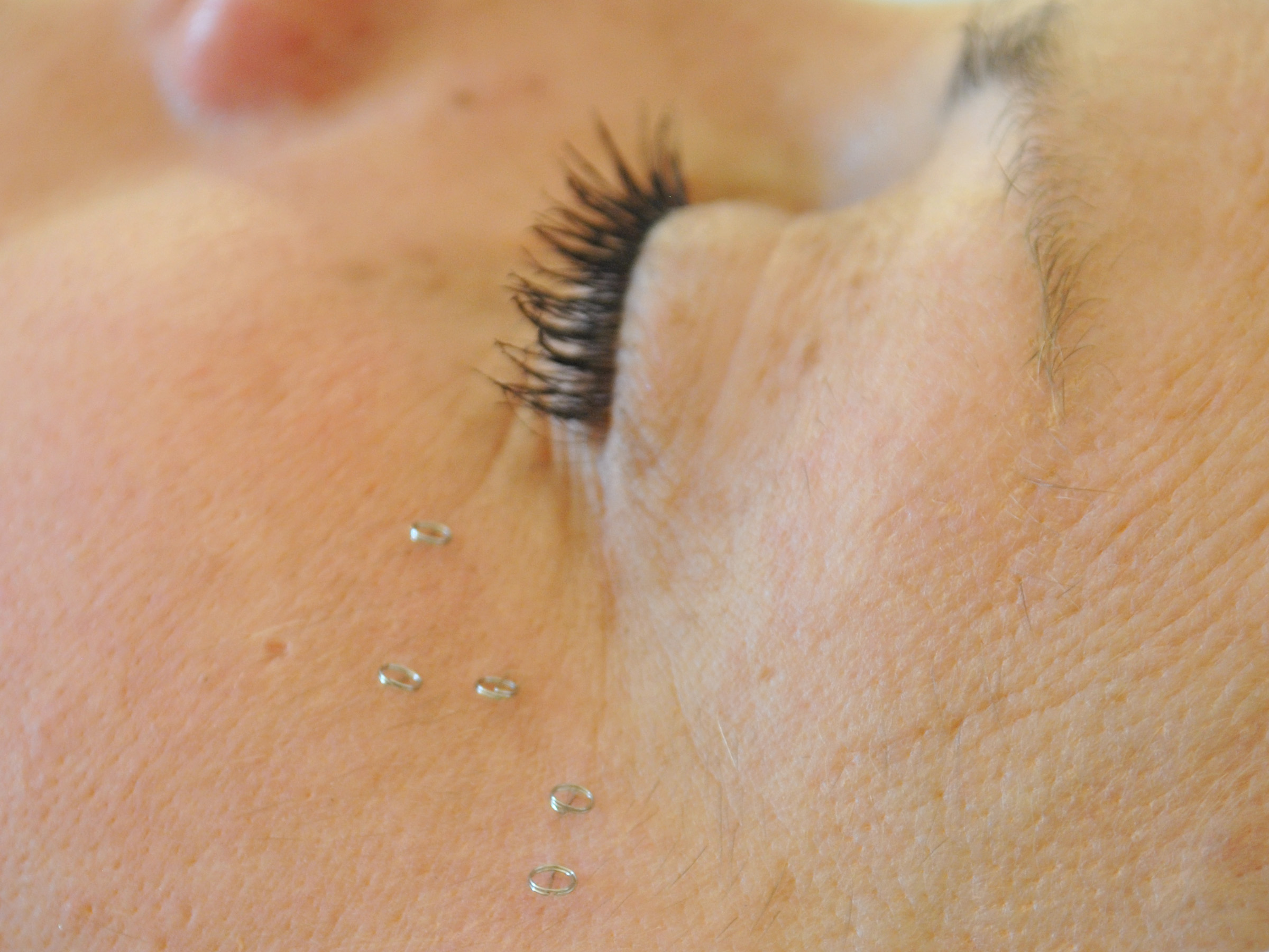 Intradermal Needles